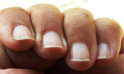Teddington Osteopaths - How do I treat Onychauxis or Thickened Nails?