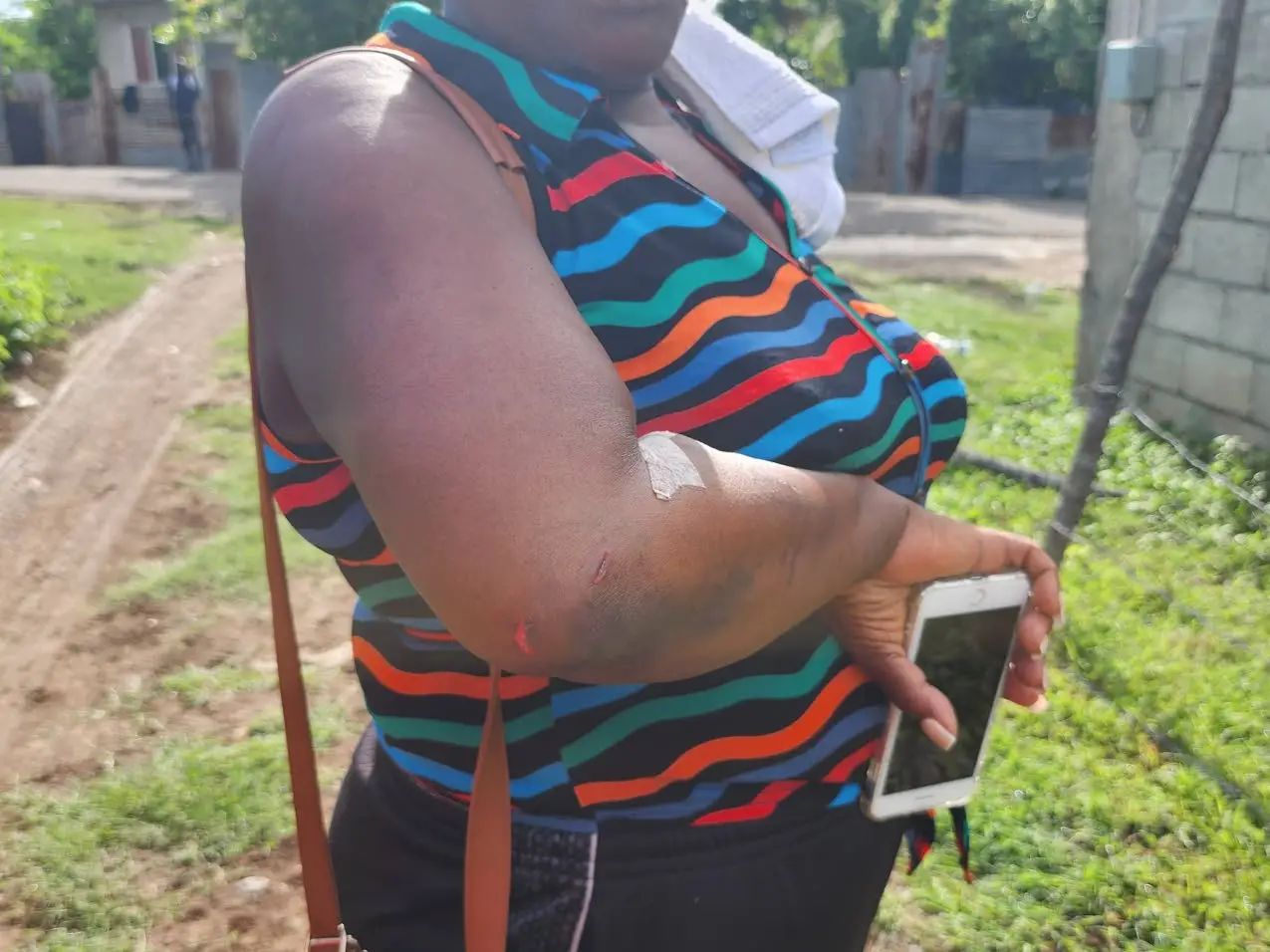 This woman who was shot in the leg, shows scars on her elbow which she sustained as she ran from the scene of the mass killing in Cherry Tree Lane, Four Paths, Clarendon, on Sunday. Photo: Llewellyn Wynter